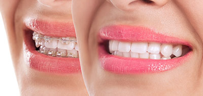 Perfect Smile Dental Studio | Preventative Program, Invisalign reg  and Dentures