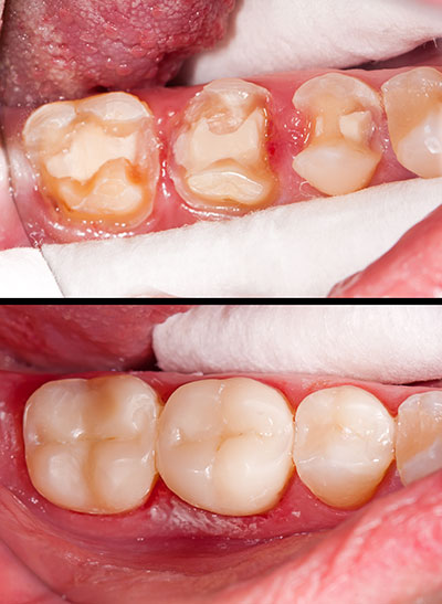 Perfect Smile Dental Studio | Dental Bridges, Extractions and K  R Whitening