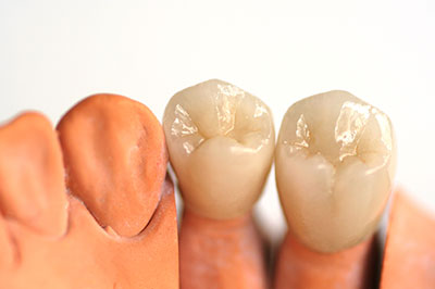 Perfect Smile Dental Studio | Sports Mouthguards, Cosmetic Dentistry and Implant Restorations