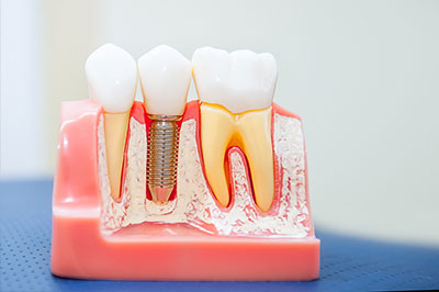 Perfect Smile Dental Studio | Dental Bridges, Teeth Whitening and Fluoride Treatment