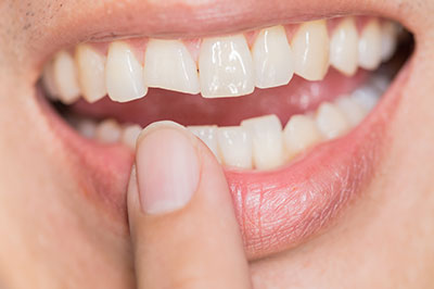 Perfect Smile Dental Studio | Ceramic Crowns, Fluoride Treatment and Crowns