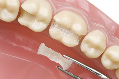 Perfect Smile Dental Studio | Implant Restorations, Inlays  amp  Onlays and Emergency Treatment