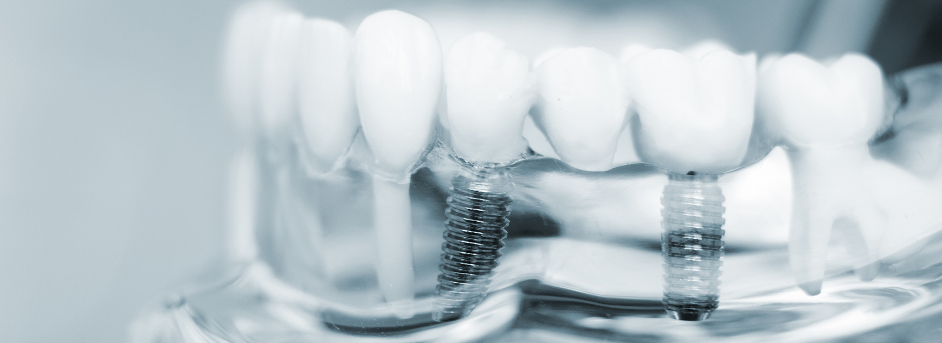 Perfect Smile Dental Studio | Dental Sealants, Periodontal Treatment and Inlays  amp  Onlays